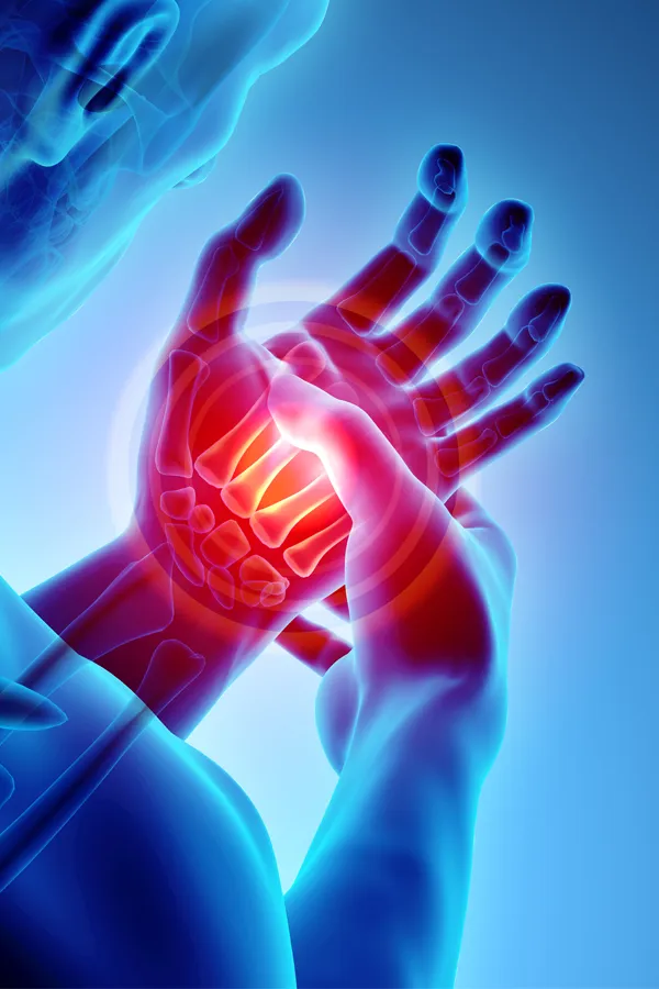 Carpal-Tunnel-Syndrome-Treatment 3D illustration of a hand with carpal tunnel syndrome. Get treatment for carpal tunnel syndrome from ProCare Wellness Institute in Savannah.