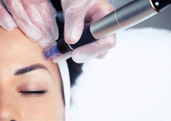 Radiofrequency-Microneedling-Specialist A woman receives a radiofrequency microneedling treatment. Get radiofrequency microneedling treatments from ProCare Wellness Institute in Savannah.