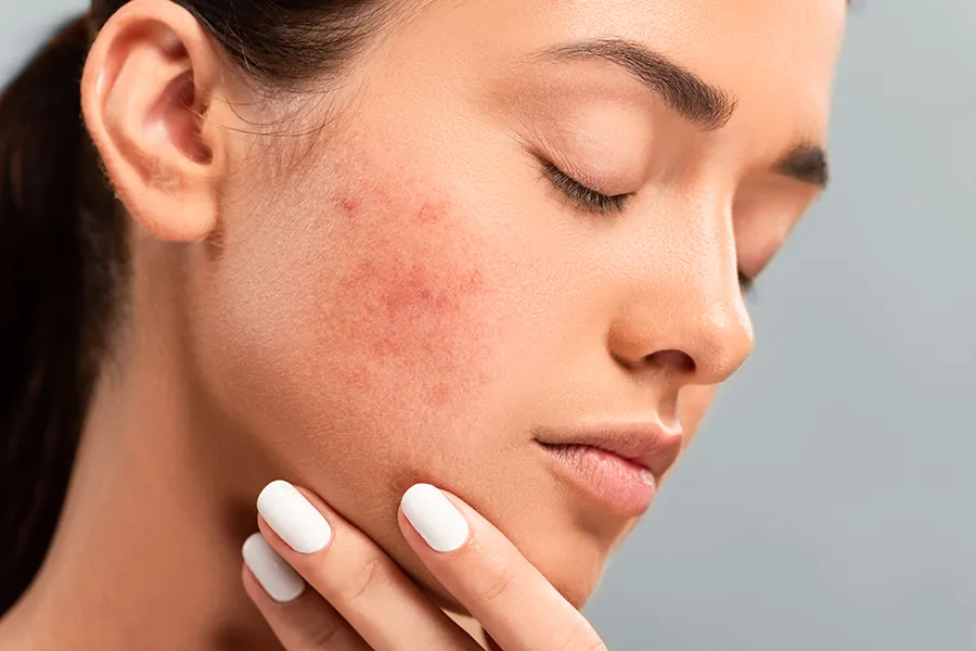 Radiofrequency-Microneedling-for-Acne-Clinic A woman with acne. Schedule Radiofrequency Microneedling for Acne Scars Treatment from ProCare Wellness Institute in Savannah.