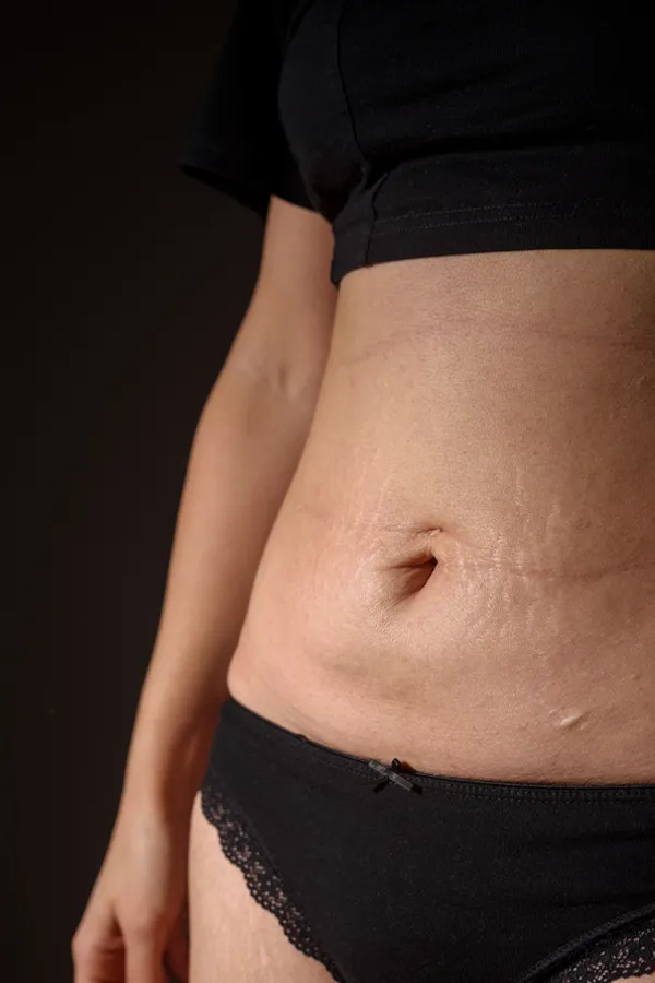 Radiofrequency-Microneedling-for-Stretch-Marks-Treatment A woman with stretch marks on her belly. Get Radiofrequency Microneedling for Stretch Marks Treatment from ProCare Wellness Institute in Savannah.